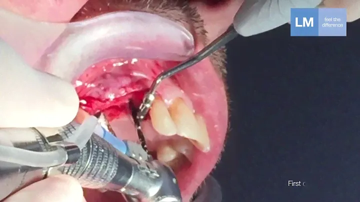 LM Implant Misura MR - инструменты для позиционирования имплантатов | LM-Instruments Oy (Финляндия)
